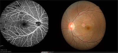 Altered Resting State Functional Activity of Brain Regions in Neovascular Glaucoma: A Resting-State Functional Magnetic Resonance Imaging Study